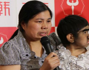 Una niña tiene exceso de vello por extraña enfermedad