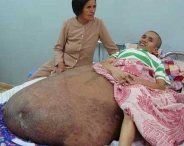 Tumor