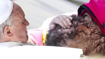 el papa bendijo a persona con rara enfermedad el papa bendijo a persona con rara enfermedad
