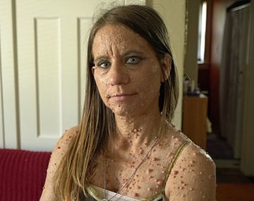 Una mujer sufre de una rara condición que le cubrió el cuerpo de más de 6.000 tumores