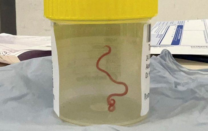 Una mujer tenía un gusano vivo en el cerebro