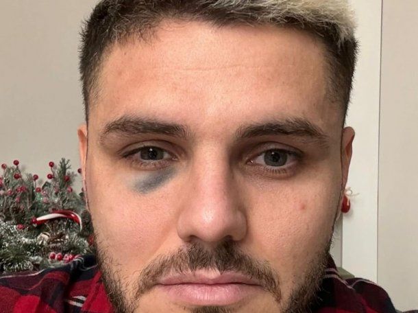 mauro-icardi-ojo-morado-1jpg