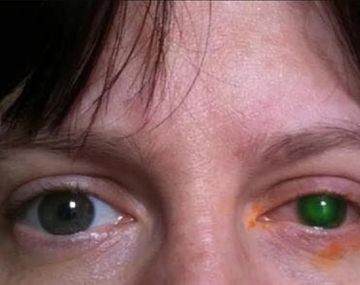 Se metió a la pileta con lentes de contacto y casi queda ciega