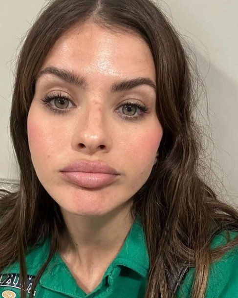 El accidente que sufrió la China Suárez: Me rompí la nariz