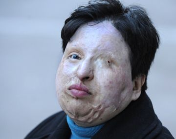 Ameneh Bahrami, una mujer iraní que también quedó ciega después de ser atacada con ácido. Foto: Lluis Gene