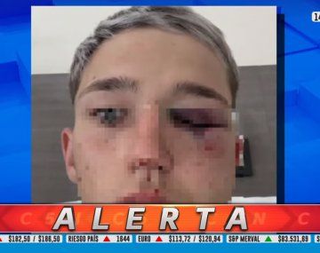 Habló el papá del chico agredido por rugbiers: No tiene sensibilidad en una parte de la cara