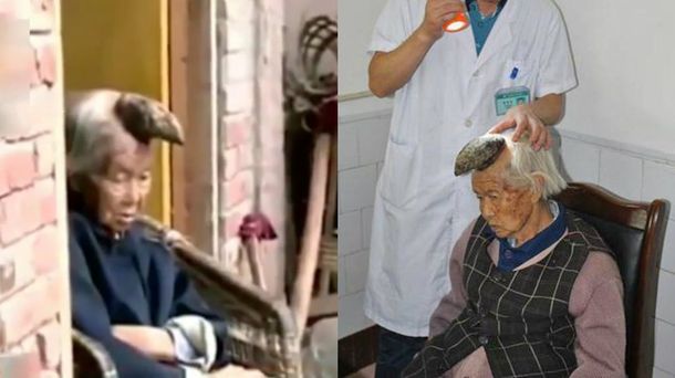 Operarán en China a una mujer unicornio para quitarle su cuerno de la cabeza