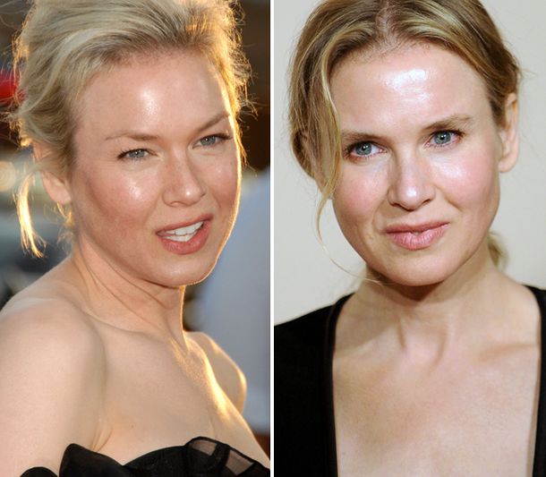 Renée Zellweger  y otra cirugía desastrosa made in Hollywood