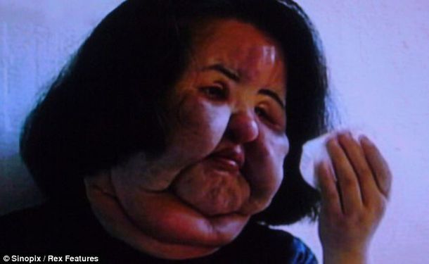Una ex modelo se inyecta aceite en la cara en su obsesión por la belleza