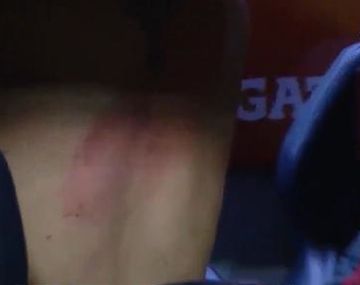 El médico de River: Tienen quemaduras de primer grado