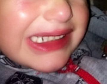 Jay Watson estuvo cinco días con un ojo pegado