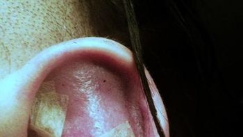 Así quedó la oreja de Marilyn Manson Así quedó la oreja de Marilyn Manson