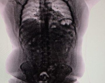 Cayó un narco que llegaba desde Perú y tenía cápsulas de cocaína en el cuerpo