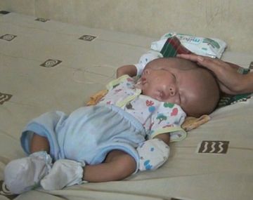 Un bebé nació con dos cabezas en Indonesia 