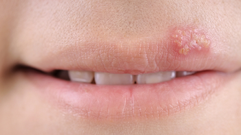 herpes: los consejos para prevenir la infeccion herpes: los consejos para prevenir la infeccion