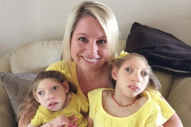 Dos hermanas con microcefalia sorprenden a los médicos con sus avances