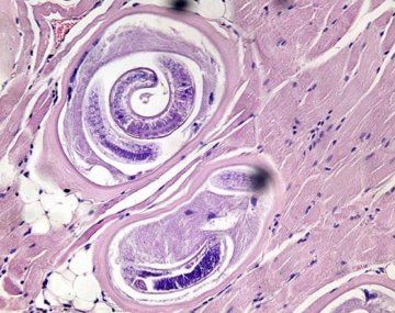 Qué es la triquinosis