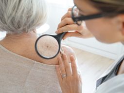 Crecieron 20% las consultas por cáncer de piel: cómo cuidarse del sol