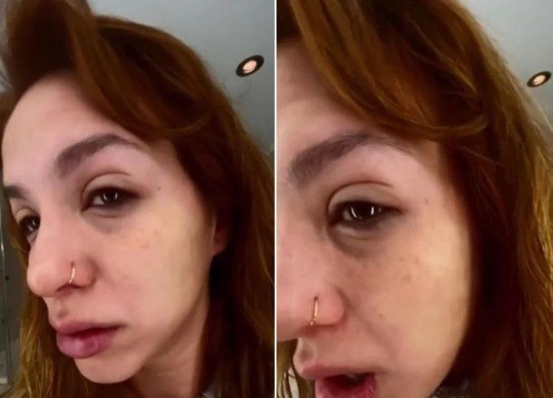 Una alergia le deformó la cara a Flor Vigna: las imágenes