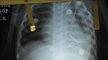 agujas en cuerpo agujas en cuerpo