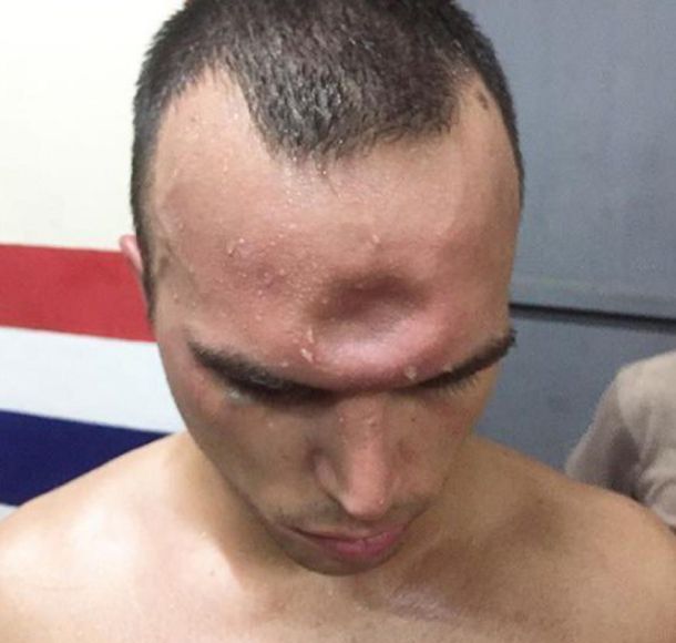 Así quedó la frente de Jeremy