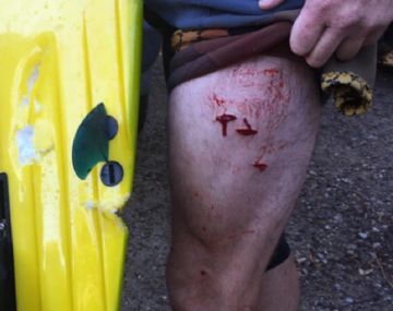 La mordida del tiburón en el muslo del surfista