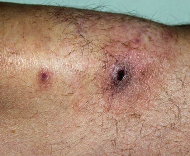Alerta por cocaína adulterada que daña la piel y las orejas