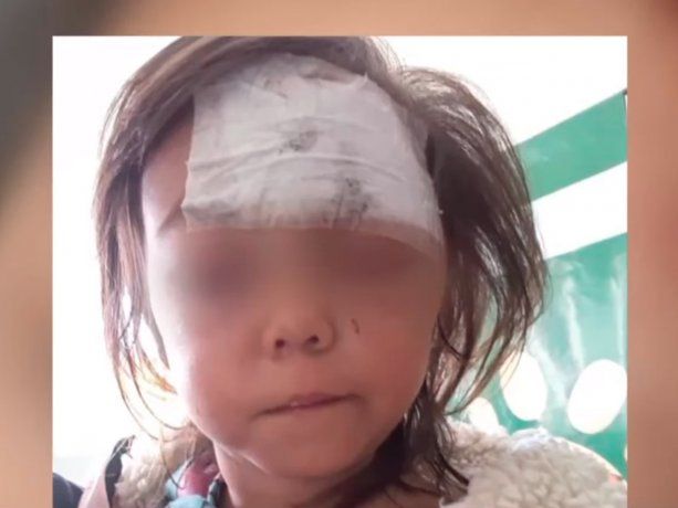 Un pitbull le desfiguró la cara a una nena de 2 años en Merlo 