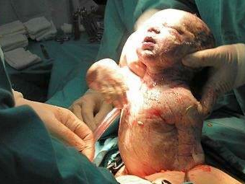 La cesárea y la evolución de la mujer