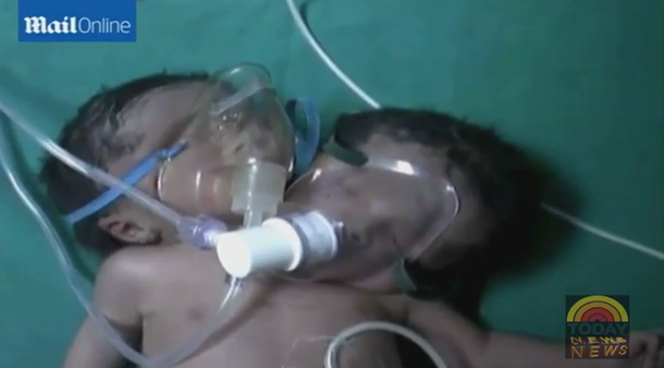 VIDEO: Nace un bebé de dos cabezas en India
