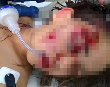 Un perro le desfiguró el rostro a una nena