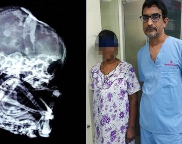 El extraño caso de la mujer que vivió con un feto petrificado durante 15 años