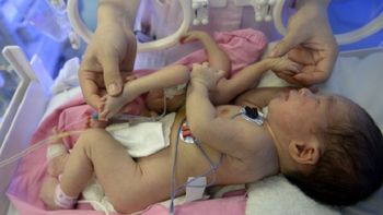 nace en china un bebe con cuatro piernas y cuatro brazos