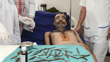 fue al medico por un fuerte dolor abdominal y le terminaron sacando 40 navajas en la panza fue al medico por un fuerte dolor abdominal y le terminaron sacando 40 navajas en la panza