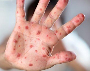 Hay alerta epidemiológica en la Ciudad por un caso de rubéola