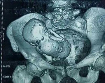 México: descubrieron un feto momificado en una mujer de 84 años