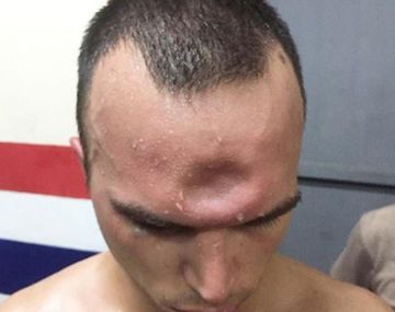 Así quedó la frente de Jeremy