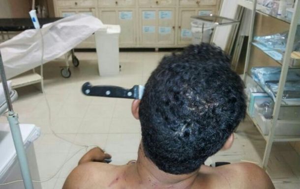 Médicos retiran un cuchillo clavado en la cabeza de un hombre