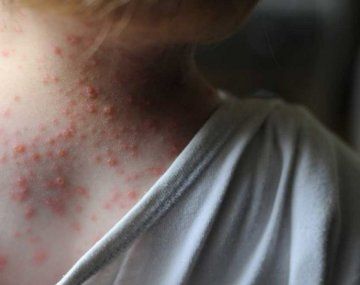 Ministerio de Salud confirmó quinto caso de viruela símica en el país
