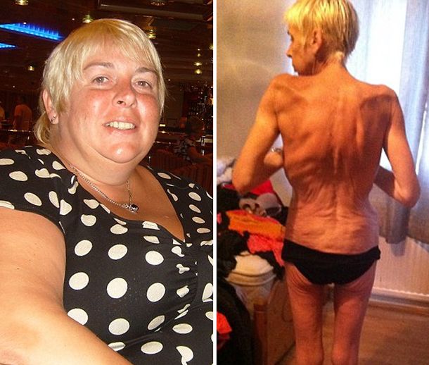 Denuncia que se volvió anoréxica por un by pass gástrico