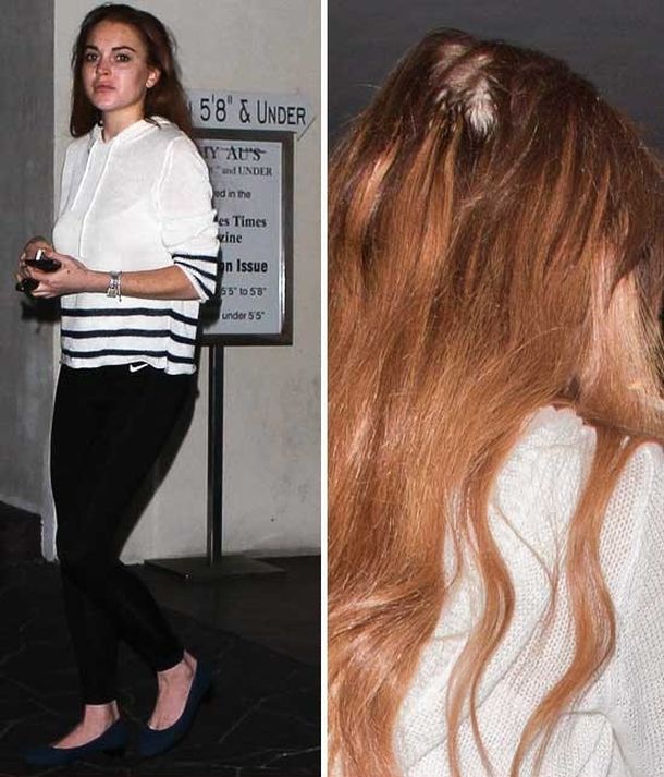 ¿Lindsay tiene un problema de calvicie?