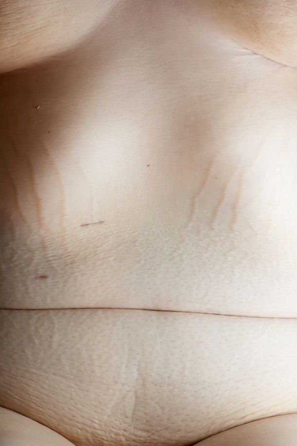 Una mujer mostró su cuerpo después de su dramática pérdida de peso