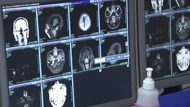 Comió carne en mal estado y más de 700 gusanos invadieron su cuerpo