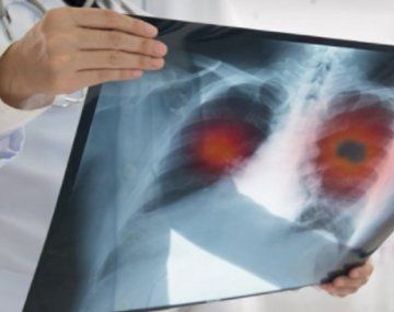 Aseguran que los pulmones de quienes superan el coronavirus quedan peor que los de los fumadores