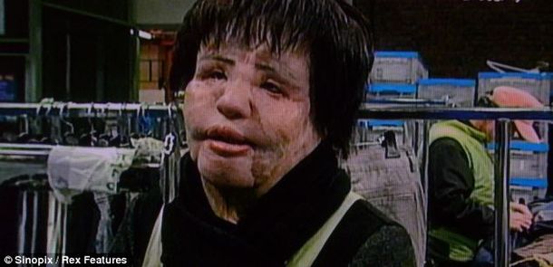 Una ex modelo se inyecta aceite en la cara en su obsesión por la belleza