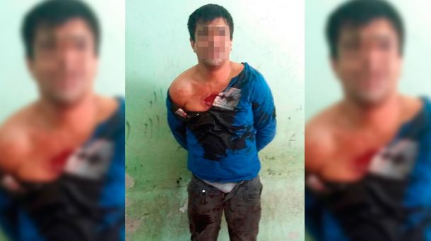 El hombre fue derivado al hospital local con varias mordeduras