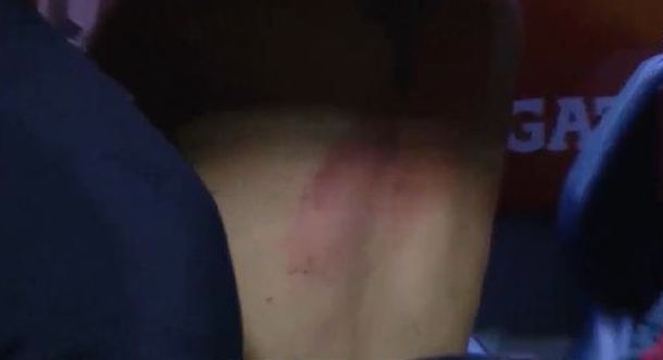 El médico de River: Tienen quemaduras de primer grado