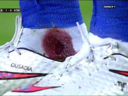 mira como le quedo el tobillo a un crack del barca despues de una patada mira como le quedo el tobillo a un crack del barca despues de una patada