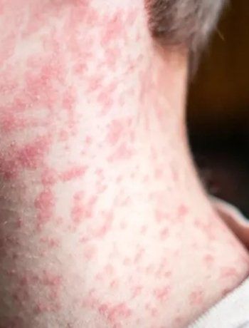 Confirman en la Ciudad el primer caso de sarampión en Argentina en 2026