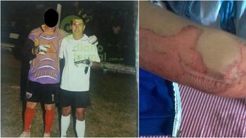 Mauricio El Torito González y el brazo herido de su pareja Mauricio El Torito González y el brazo herido de su pareja